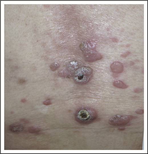 Figure 7. PCALCL with multiple papules and tumors grouped on the back.