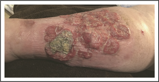 Figure 8. Cutaneous ALCL with extensive single-limb disease.