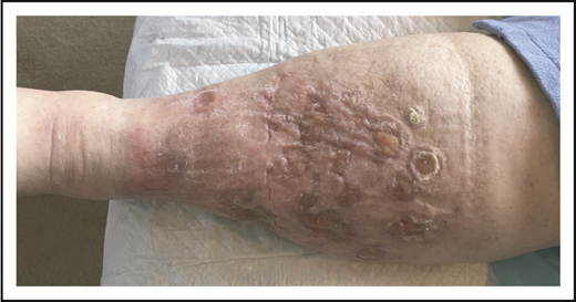 Figure 9. Extensive cutaneous ALCL after treatment with 8 cycles of BV.