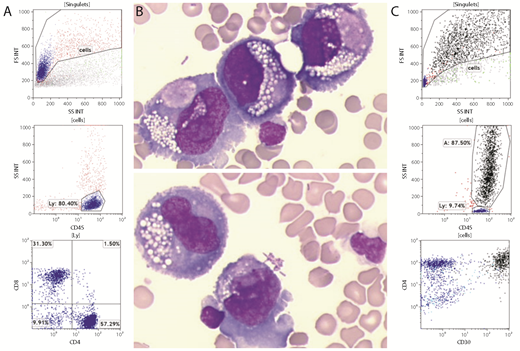 A 69-year-old woman who had a mastectomy with reconstruction using a textured implant 14 years ago presented with a periprosthetic effusion that was investigated for breast implant–associated anaplastic large-cell lymphoma (BIA-ALCL) by aspiration for cytology and flow cytometry (FCM). Although FCM analysis using the routine forward scatter/side scatter (FSC/SSC) settings primarily showed a population of normal T lymphocytes (panel A), cytology revealed atypical large pleomorphic cells with abundant vacuolated basophilic cytoplasm and prominent nucleoli (panel B, original magnification ×500; May-Grünwald-Giemsa stain). Thus, a second FCM analysis was performed with decreased FSC/SSC voltage and gain values. These modified settings detected CD45+/CD3−/CD4+/CD2+/CD5−/CD7− cells with high FSC/SSC and strong expression of CD30 (panel C). Immunohistochemistry performed on the capsulectomy specimen confirmed the diagnosis of BIA-ALCL. / Most BIA-ALCL patients have disease that is localized to the capsule with an excellent outcome after surgery alone. However, cases like the one presented here with tumor cells spreading to adjacent lymph nodes or other organs (bone metastases) have a worse prognosis and require chemotherapy in addition to capsulectomy. This case highlights the contribution of cytology and FCM to the diagnosis of BIA-ALCL; however, modified FSC/SSC settings are needed to avoid false-negative FCM results.