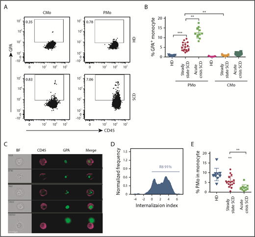 Figure 1. Circulating PMos engulf sickle RBCs in SCD. (A) Representative dot plots comparing GPA+ (an RBC marker) CMos (CD45+HLA-DR+SSChiCD14hiCD16−) and PMos (CD45+HLA-DR+SSChiCD14lowCD16+) from race-matched HDs and patients with SCD. For the gating strategy used, see supplemental Figure 4A. (B) Frequencies of GPA+ circulating monocyte populations in HDs (n = 17), patients with SCD at steady state (n = 17), and during acute crisis (n = 11). (C) Representative IFC images acquired simultaneously and gated on GPA+ PMos from patients with SCD (from A). Left to right: single-channel bright field (BF), CD45 (representing PMos in purple), GPA (representing RBC materials in green), and merged images showing GPA+ materials within CD45+ cells in the top 4 rows, but not in the bottom row, where GPA+ material is attached to the external surface of PMos. (D) Histogram depicting degree of GPA+ material internalized within PMos with internalization score (<0 represents GPA+ material attached to the surface of PMos; >0 represents GPA+ material internalized by PMos). Percentage of cells with an internalization score >0 is indicated. (E) Frequency of PMos within total circulating monocytes from HD (n = 10), patients with SCD at steady state (n = 17), and during acute crisis (n = 11) were determined by FCM. Data represent mean ± SEM; means were compared using a 2-tailed Student t test. **P < .01; ***P < .001.
