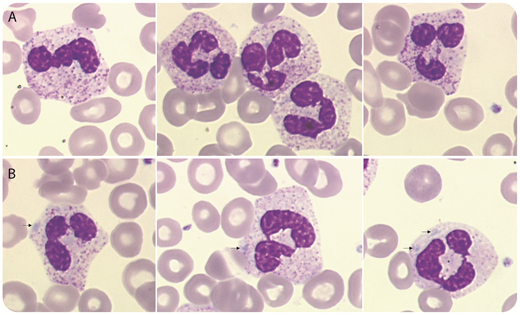 A 69-year-old man was referred for unexplained leukocytosis, discovered 4 months earlier. Clinical examination revealed splenomegaly, and C-reactive protein was normal. The blood count showed anemia (hemoglobin, 96 g/L) and confirmed leukocytosis (white blood cell count, 81 × 109/L), with 69.7 × 109/L (relative value 86%) neutrophils. Toxic granulations (panel A; original magnification ×1000, May-Grünwald-Giemsa stain) and Döhle bodies (arrows, panel B; original magnification ×1000, May-Grünwald-Giemsa stain), commonly found in reactive conditions, were observed. Some neutrophil precursors (5.7 × 109/L, relative value 7%) and a slight monocytosis (1.6 × 109/L, relative value 2%) were present, but no basophils were observed. BCR-ABL1 fusion gene and JAK2, CALR, and MPL mutations were absent. Next-generation sequencing revealed CSF3R T618I, SETBP1 D868N, and ASXL1 L775X mutations. These results converged to point to a diagnosis of chronic neutrophilic leukemia (CNL). / CNL is a rare Philadelphia-negative myeloproliferative neoplasm whose true incidence is unknown. The close association between activating mutations of the CSF3R gene and CNL has recently refined its diagnosis. Therefore, with regard to >200 previously described cases, only some would meet current diagnostic criteria. This is particularly useful for differentiating CNL from neutrophil leukemoid reaction, secondary to other diseases (multiple myeloma or monoclonal gammopathy of undetermined significance, in particular). CNL is considered a slowly progressing disease, but survival varies greatly. The coexistence of an ASXL1 mutation may be associated with a poorer prognosis.