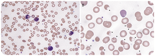 A 9-year-old boy with presumed attention-deficit hyperactivity disorder presented with jaundice/fatigue/headache/elevated creatinine/loose stools. He was investigated for acute hemolytic anemia (HA) including hemolytic uremic syndrome. His complete blood count showed: white blood cells, 16.7 × 109/L; hemoglobin, 69 g/L; reticulocytes, 214 × 109/L; platelets, 168 × 109/L (normal, 180 × 109/L to 440 × 109/L); bilirubin, 471 μM/L; lactate dehydrogenase, 896 U/L; haptoglobin, <0.07 g/L; plasma-free hemoglobin, 1.28 g/L (normal, 0.01-0.05 g/L). The blood smear (BS) demonstrated marked echinospherocytosis/target cells/polychromasia (panel A; Wright stain, original magnification ×40)/bite/blister cells (panel B; Wright stain, original magnification ×100) with no schistocytosis, consistent with oxidative hemolysis. Direct antiglobulin test/hepatitis serology/glucose-6-phosphate dehydrogenase/molecular tests for enteric pathogens including Escherichia coli O157 were negative. The patient developed fulminant hepatic failure (FHF) with: aspartate aminotransferase, 256 U/L; alkaline phosphatase, 45 U/L; γ-glutamyl transferase, 156 U/L; albumin, 21 g/L; international normalized ratio, 3.1; partial thromboplastin time, 53 seconds; and fibrinogen, 1.1 g/L. Serum ceruloplasmin was decreased 6.9 mg/dL (normal, 24-50 mg/dL); serum copper was elevated 48.4 µM/L (13.2-21.4 µM/L). A clinical diagnosis of Wilson disease with FHF was made based on the BS/laboratory tests/clinical presentations. The patient was transferred for urgent liver transplantation. / HA was the presenting manifestation in ∼5% to 6% of patients with Wilson disease, especially in children/young adults with FHF. It is believed that HA is related to the release of copper into the blood from hepatocytes necrosis, causing oxidative damage to the erythrocytes.