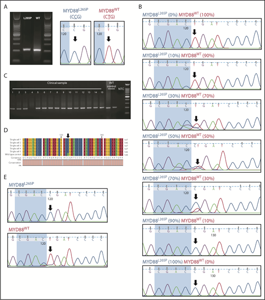 Figure 1. Sanger sequencing detection limit and single-cell MYD88 PCR analysis. (A) MYD88 PCR was conducted to amplify both MYD88L265P and MYD88WT alleles. Amplified sequences were verified to encode either CCG or CTG corresponding to the mutant MYD88L265P and MYD88WT alleles, respectively. (B) The PCR amplicons were mixed in titrating proportions to determine the Sanger sequencing detection limit. The lowest detection limit of Sanger sequencing in detecting MYD88L265P and MYD88WT MYD88 alleles was ∼30%. (C) Single-cell MYD88 PCR was conducted on a clinical DLBCL sample with 15 single cells (1-15); 14 of 15 cells gave a PCR band of ∼200 bp. (D) Multiple sequence alignment of the excised and sequenced PCR amplicon showed a T → C point mutation in 5 representative cells from clinical samples but not in Pfeiffer cells (a germinal center B cell–like DLBCL exhibiting the MYD88WT allele). (E) Electropherogram showed clean and well-resolved sequencing peaks for MYD88L265P and MYD88WT. The black arrows throughout indicate the location of the point mutation. NTC, no template control; WT, wild type.