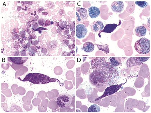 A 52-year-old man presented with persistent leukocytosis after cannabis and tobacco withdrawal. Blood count showed the following: hemoglobin, 130 g/L; leukocytes, 68 × 109/L; platelets, 138 × 109/L; neutrophils, 45 × 109/L; eosinophils, 1.4 × 109/L; and monocytes, 5.5 × 109/L. Neutrophils precursors accounted for 17% of leukocytes. The peripheral blood smear showed rare blast cells (<1%). Bone marrow smears revealed increased cellularity with excess of eosinophilic precursors (6%) and no excess of blast or dysgranulopoiesis (panel A; May-Grünwald-Giemsa stain, original magnification ×50). Interestingly, an infiltration by abnormal spindle-shaped mast cells was found (0.5%) (panels B-D; May-Grünwald-Giemsa stain, original magnification ×100). Conventional cytogenetic showed a rare t(5;12)(q33;p13) resulting in the ETV6-PDGFRB fusion gene confirmed by fluorescence in situ hybridization. The patient was diagnosed with myeloid neoplasm with eosinophilia and PDGFRB rearrangement. / PDGFRB-rearranged neoplasms result in a spectrum of morphological presentations that include myeloproliferative and myelodysplastic/myeloproliferative neoplasms and rarely acute myeloid leukemia. ETV6-PDGFRB fusion gene may be associated to eosinophilia and monocytosis. Presence of abnormal mast cells has been already reported in PDGFRA-rearranged neoplasms, but it is uncommon in PDGFRB rearrangement. The patient was treated with imatinib and achieved a complete hematologic remission after 1 month of treatment.