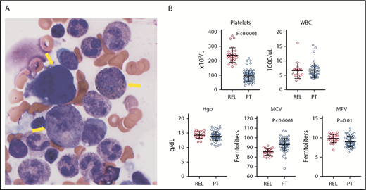 Figure 1. Abnormal bone marrow histology and CBCs in patients with ETV6-related thrombocytopenia and leukemia predisposition. (A) Abnormal cellular features (yellow arrows) with hyperchromatic small megakaryocytes, disseminated toxic granulations, and dysplastic eosinophils (magnification ×100; Wright-Giemsa stain). (B) Platelet count, white blood cell (WBC) count, hemoglobin (Hgb), mean cell volume (MCV), and mean platelet volume (MPV) in patients (PT) with germ line mutations in ETV6, as compared with related individuals (Rel) without mutation (Student t test).3-6,9,10