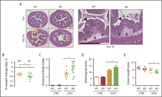 Figure 1. HYAL2 KO mice are more susceptible to DSS-induced colitis. (A) Cross-sections of distal colon collected from mice after 7 days of colitis induction with 2.5% DSS. Hematoxylin-eosin staining highlights the cellular and structural changes in the intestine, including inflammatory leukocyte infiltration. Boxed regions are enlarged in adjacent panels. Scale bars indicate 500 μm. L denotes the intestinal lumen, triangles indicate the epithelial layer, S denotes the submucosa, and arrows indicate the muscularis mucosae. (B) Body weight was measured on day 7 and compared with starting weight. (C) Mice were scored for outward signs of disease, including weight loss, hunched posture, ruffled fur, bloody stools, and rectal prolapse. (D) Distal colon sections from mice after 7 days of DSS were scored for pathologic changes, including erosion of the epithelial layer, leukocyte infiltration, submucosal swelling, muscularis mucosae hyperplasia, and increased vascularization. (E) Colons from mice euthanized after 7 days of DSS were measured for distance (centimeters) from the distal end of the cecum to the rectum. Symbols represent individual mice. Symbols indicate genotypes: (▲) WT mice and (●) HYAL2 KO mice. Data are reported as mean ± SEM; n = 10 mice per group. *P < .05.