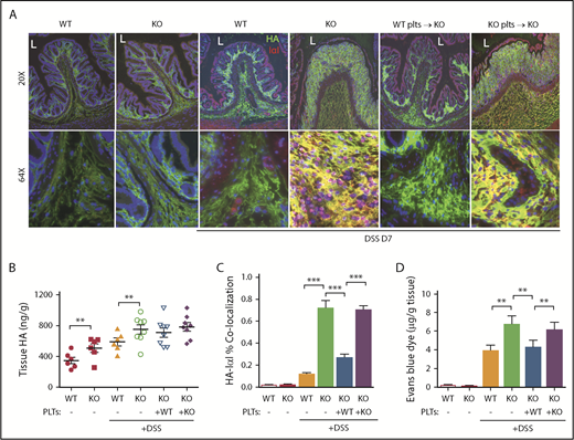 Figure 6. Microvascular permeability is increased in mice with DSS-induced colitis with HYAL2-deficient platelets. (A) Distal colon sections from mice treated with 2.5% DSS for 7 days with or without transfusion of platelets were evaluated for HA-HC by immunostaining for HA (green) and the HCs of IαI (red) and counterstained with 4′,6-diamidino-2-phenylindole for nuclei. L denotes the lumen. Lower panels show the submucosal regions at higher magnification. Images are representative of at least 8 mice. (B) Measurement of HA levels in colon tissue from control, DSS-treated mice, and DSS-treated mice receiving platelets. (C) Quantification of colocalization of HA with HCs of IαI as a measurement of HA-HC deposition. (D) Measurement of EB extracted from distal colon tissue of mice treated with or without 2.5% DSS. Data are reported as mean ± SEM; n = 10 mice per group. *P < .05; **P < .01; ***P < .001. Imaging, detection, and software details: TCS SP5 II confocal/multiphoton high-speed upright microscope, HCX PL APO 40X/1.25NA oil immersion objective, HyD system detector, and LAS AF software (all Leica Biosystems). Pearson’s correlation coefficients were obtained by analyzing individual images (layers) of the Z-stack with Image-Pro Plus software.
