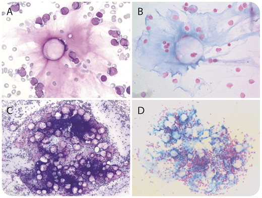 A 13-year-old boy was referred for weight loss, polyuria, polydipsia, asthenia, and pancytopenia. Bone marrow (BM) smears revealed the presence of 81% medium-sized lymphoblasts. A diagnosis of B-cell acute leukemia (European Group for the Immunological Characterization of Leukemias stage B-II) with t(12;21) ETV6-RUNX1 rearrangement was established. Unexpectedly, BM smear examination also revealed amorphous bluish-pink substance deposits within the stroma associated with microadipocytes (panels A and C; May-Grünwald-Giemsa stain, 60× and 10× objectives, respectively). Alcian blue staining confirmed the gelatinous transformation of the BM (GTBM; panels B and D; 60× and 10× objectives, respectively). No BM biopsy was performed. Simultaneously, blood tests displayed marked hyperglycemia combined with elevated glycated hemoglobin. Increases of anti-insulin, anti-GAD, and anti–IA-2A autoantibody levels further demonstrated the concomitance of GTBM, type-1 diabetes mellitus, and lymphoblastic leukemia. / GTBM features include adipocyte atrophy, hematopoietic tissue hypoplasia, and extracellular deposition of gelatinous substance (acid mucopolysaccharides). GTBM has been described in association with various chronic malnutrition conditions and is usually seen in anorexia nervosa, AIDS, or cachexia. In rare cases, GTBM has been reported at diagnosis of acute leukemia, but it has also been described in other abnormal metabolic conditions, such as diabetes mellitus, as described here. No GTBM was observed after induction chemotherapy and diabetes mellitus management. The patient remains in remission after consolidation with undetectable ETV6-RUNX1 transcript but subnormal complete blood count.