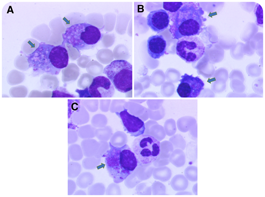 A 60-year-old man with a 1-year history of chronic kidney disease (estimated glomerular filtration rate 53 mL/min per 1.73 m2) and hypouricemia was referred for nephrology work-up. He had hypophosphatemia, proteinuria (0.94 mg/mg), and normoglycemic glycosuria. Kidney biopsy was consistent with Fanconi syndrome (FS), and serum immunofixation showed monoclonal κ light chains (LCs). The bone marrow (BM) smear showed 6% plasma cells (PCs) (see panels A-C for 3 aspects), with crystalline cytoplasmic inclusions (see arrows, original magnification ×1000; May-Grünwald Giemsa stain) and abnormal phenotype by flow cytometry (CD19lo, CD117+, monotypic κ). Targeted next-generation sequencing (NGS) showed partial 11q gain, translocation t(11;14), and clonal IRF4 mutation.