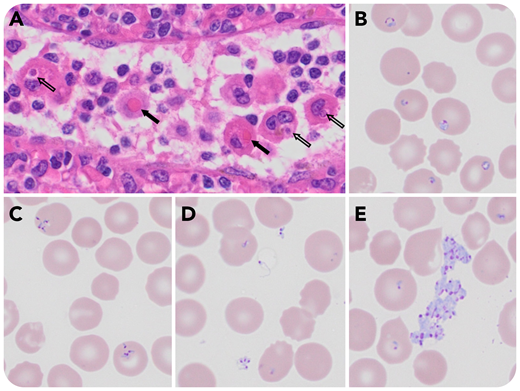 A 72-year-old woman presented with a 2-year history of splenomegaly, thrombocytopenia, and transfusion-dependent Coombs-negative hemolytic anemia. She visited Long Island for the past 2 summers. After her most recent trip, she experienced intermittent fevers and chills with no identifiable etiologies. After splenectomy to evaluate for occult lymphoproliferative disorder, her symptoms resolved, but recurred 3 weeks later. Upon admission, she met the criteria for hemophagocytic lymphohistiocytosis (HLH) based on ferritin (15 174 ng/mL), triglyceride (291 mg/dL), soluble interleukin 2 receptor (41 500 pg/mL), fibrinogen (132 mg/dL), hemoglobin (7.5 g/dL), and platelet (41 000/µL) parameters. The spleen showed histiocytes phagocytosing erythrocytes (panel A, black arrows) and nucleated cells (panel A, open arrows; original magnification ×600, ×60 objective, hematoxylin and eosin stain). She was started on etoposide and dexamethasone for HLH. Because of persistent pancytopenia and fevers, peripheral blood smears were evaluated, revealing numerous intracellular ring forms (panel B), tetrad-forms or “Maltese Cross” (panel C), and extracellular protozoa in isolation (panel D) or clusters (panel E; panels B-E: original magnification ×1000, ×100 objective, Wright stain). Positive Babesia microti immunoglobulin M and immunoglobulin G antibody titers confirmed babesiosis. After 4 weeks of HLH induction regimen, azithromycin and atovaquone, and a single exchange transfusion, her symptoms, HLH parameters, and parasitemia improved markedly.