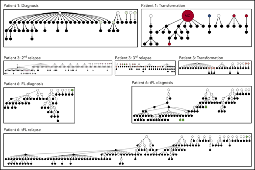 Hierarchy of N-gly site-negative clones in relation to their direct ancestral clone for patients 1, 3, and 6. This diagram represents part of the lineage trees, as the majority of subclones (which are positive) are not shown and the interconnection between clones from a germline sequence is not depicted. Only the negative subclones, their parent clone, and their progenitor clones are depicted here to highlight their generation and contribution to the clonal repertoire within an event. For all patients, black nodes represent N-gly site-negative clones. White nodes represent clones not detected by the sequencing platform, but predicted to exist by the IgTree program. All white nodes are assumed to contain the N-gly site because of a number of other experimentally detected progeny clones being site-positive. Gray nodes in the patient 1 diagnosis event represent N-gly site-positive subclones that contain the same N-gly site-encoding codon sequence to the major clone. Dark red nodes in the patient 1 transformation represent N-gly site-positive subclones that contain the same N-gly site-encoding codon sequence to the major clone of the event. Pink nodes in patient 3 represent N-gly site-positive subclones that contain the same N-gly site-encoding codon sequence to the major clone of the event. Green nodes in patient 6 represent N-gly site-positive subclones that contain the same N-gly site-encoding codon sequence to the major clone of the event. Other colored nodes in trees represent N-gly site-positive clones, which contain a different codon sequence in the N-gly site compared with the major clone of the disease event. The full lineage trees can be requested from the corresponding author.