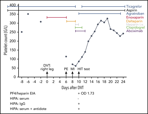 At day −20, the 59-year-old female patient had an ST-segment elevation myocardial infarction and cardiac arrest. She required cardiopulmonary resuscitation during which a bolus of unfractionated heparin was given, followed by placement of 3 drug-eluting stents in the right coronary artery. Resuscitation was complicated by liver laceration requiring surgery. No thrombosis prophylaxis was given because of the anticipated risk of bleeding after liver injury. Therapeutic-dose low molecular weight heparin was started at day 0 upon diagnosis of a deep vein thrombosis (DVT) of the right leg (enoxaparin; 1 mg/kg body weight twice a day subcutaneously). Severe pulmonary embolism (PE) occurred at day 6, and the platelet count had decreased to 114 per microliter. Anticoagulation was switched to dalteparin (5000 aFXaU twice a day subcutaneously). Three days later, the patient was transferred to the hospital of 1 of the authors (C.P.) with a further myocardial infarction (MI) due to in-stent thrombosis of the right coronary artery. Heparin-induced thrombocytopenia was suspected; the 4T score was 7. All heparins were stopped, and anticoagulation was switched to argatroban. In addition, abciximab and clopidogrel were given. The patient was discharged at day 25 and has remained stable. “HIT test” denotes the time point at which a blood sample was taken for HIT diagnosis; test results are shown below the graph. The PF4/heparin EIA was strongly positive (OD 1.73), but the HIPA was negative.