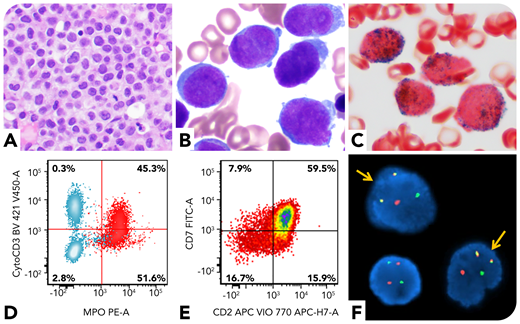 A 59-year-old man presented with oral bleeding. Peripheral blood showed leukocytosis (59.6 × 109/L; 83% blasts). Bone marrow biopsy revealed markedly increased immature cells (panel A; hematoxylin and eosin stain, ×40 objective, original magnification ×400). Aspirate smear showed blasts with round to irregular nuclei, fine chromatin, and small amount of cytoplasm; no obvious Auer rods were identified (panel B; Wright and Giemsa stains, ×100 objective, original magnification ×1000). The blasts were positive for myeloperoxidase (panel C; cytochemical stain, ×100 objective, original magnification ×1000). Flow cytometry showed the blasts (CD34+CD117+HLA-DR−) coexpressed myeloid (myeloperoxidase, CD13, and CD33) and T-lineage (cytoplasmic CD3, CD2, and CD7) markers, suggestive of mixed-phenotype acute leukemia (MPAL), T/myeloid (panels D-E; red cells in panel D are blasts, and blue cells in panel D are T and B cells in the background). However, his D-dimer level was markedly increased (>20 μg/mL fibrinogen equivalent units; normal range 0-0.4), accompanied by a decreased fibrinogen level, concerning for acute promyelocytic leukemia (APL). Fluorescence in situ hybridization confirmed PML/RARA rearrangement (panel F, yellow arrows; original magnification ×1000). Molecular studies revealed an internal tandem duplication and a D835 point mutation of the FLT3 gene. He was diagnosed with microgranular APL.