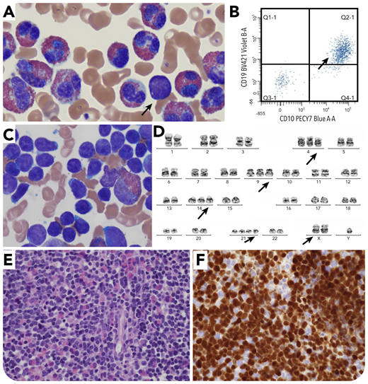 A 13-year-old boy with autism spectrum disorder presented to the Emergency Department with left flank pain and hepatosplenomegaly. Laboratory workup showed an absolute eosinophil count of 65 280 × 109/L and white blood cell count of 88 200 × 109/L in the absence of anemia or thrombocytopenia. Peripheral smear review confirmed marked eosinophilia (75%) with very few (1%) circulating lymphoblasts (panel A; Wright-Giemsa, original magnification ×100), positive by flow cytometry for CD10 (bright) and CD19 (panel B), along with CD34, TDT, CD22, cCD79a, HLA-DR, CD9, CD58, and CD123. Bone marrow examination showed 70% to 80% involvement by B-lymphoblastic leukemia/lymphoma (B-ALL), with aspirate demonstrating sheets of blasts admixed with eosinophils/eosinophilic precursors (panel C; Wright-Giemsa, original magnification ×100). The core biopsy showed 70% to 80% B-ALL lymphoblasts (panel E; hematoxylin and eosin, original magnification ×40), which are TDT positive (panel F; TDT, original magnification ×40), along with admixed eosinophils/eosinophilic precursors. The cytogenetic study showed high hyperdiploid karyotype: 52,XY,+X,+4,+9,+14,+21,+21 (panel D). The most common translocation t(5;14) (q31;q32) associated with B-ALL cases with hypereosinophilia, as well as relatively less common recurrent abnormalities such as translocation t(7;12)(q22;p13) and deletions involving 5q, 7q, were not identified.