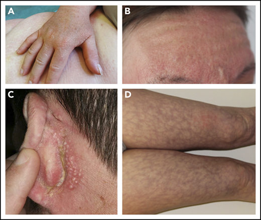 Skin features in scleromyxedema. Papules on hands (A), glabella (B), and retroauricular area (C).(D) Livedo racemosa.