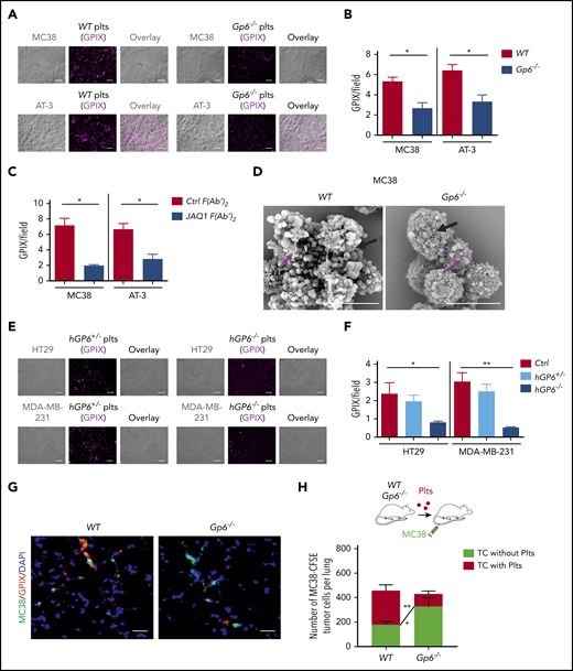 Genetic deficiency or antibody-mediated blockade of GPVI impairs platelet–tumor cell interaction. Platelet adhesion to tumor cells was quantified based on the fluorescence detection of anti-GPIX–labeled platelets, as described in “Materials and methods.” (A-B) Washed WT or Gp6−/− mouse platelets (Plts) were allowed to adhere to MC38 colon and AT-3 breast cancer cells. The bar represents 20 µm. (C) Similar experiments were performed with WT mouse platelets treated with JAQ1 F(abʹ)2 or an irrelevant control F(abʹ)2 antibody. (D) Representative SEM images of WT and Gp6−/− mouse platelets adhering to MC38 tumors cells. Washed mouse platelets were mixed with MC38 colon cancer cells (100 platelets/cell), incubated for 1 hour at 37°C, and then analyzed by SEM. The bar represents 8 μm. Arrows indicate platelets (magenta) and tumor cells (black). (E-F) Washed human platelets were isolated from patients carrying the heterozygous (GP6+/−) or homozygous (GP6−/−) mutation in the GP6 gene or from healthy donors and coincubated with human HT29 colon and MDA-MB-231 breast cancer cells. Shown are representative images of GP6+/− and GP6−/− platelets adhering to HT29 and MDA-MB-231 cells. The bar represents 20 µm. (B-C,F) Quantification of the fluorescence signal corresponding to the number of mouse (B-C) and human (F) platelets adhering to tumor cells. (B-C) Mean ± standard deviation (SD); n = 4 mice per group; *P < .05, by Mann-Whitney test. (F) Mean ± SD; Ctrl (healthy donor), n = 3; GP6+/−, n = 2; and GP6−/−, n = 3. *P < .05; **P < .01, by unpaired Student t test. (G,H) Experimental design: thrombocytopenic mice were transfused with Cy3-conjugated anti-GPIX-labeled WT or Gp6−/− platelets (red) and CFSE-labeled MC38 tumor cells (green). One hour after injection, mice were euthanized, the lungs were collected, and the colocalization of MC38 tumor cells with platelets was determined by confocal microscopy. Nuclei were stained with 4′,6-diamidino-2-phenylindole (DAPI; blue). The bar represents 20 µm. (H) Quantification of the number of tumor cells surrounded or not by platelets. Mean ± SD, n = 4 mice per group, tumor cells (TC) without Plts WT vs Gp6−/−, *P < .05; TC with Plts WT vs Gp6−/−; **P < .01, by 2-way analysis of variance with Bonferroni's multiple-comparison test.