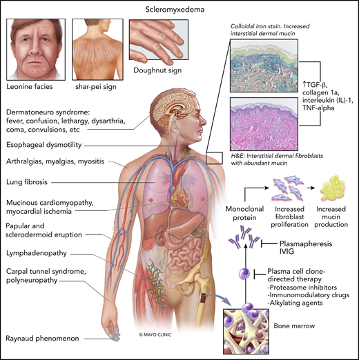Clonal plasma cells residing within the bone marrow produce circulating monoclonal proteins that may subsequently lead to increased proliferation of dermal fibroblasts and excess mucin production. This pathologic process results in the myriad of depicted cutaneous and extracutaneous manifestations of scleromyxedema. Key cutaneous signs depicted include (a) leonine facies: deeply furrowed “lumpy” face with prominent superciliary arches resembling that of a lion, (b) the shar-pei sign: deep furrows in the skin of the back characteristic of the shar-pei breed of dog, and (c) the doughnut sign: induration of skin with central depression over proximal interphalangeal joint. Possible therapies include treatments directed against the plasma cell clone or the circulating monoclonal protein. H&E, hematoxylin and eosin; TGF-β, transforming growth factor-β; TNF-alpha, tumor necrosis factor-alpha. Joanna R. King (Mayo Clinic, Rochester) provided assistance to the authors in creating the figure; Julia S. Lehman (Mayo Clinic, Rochester) shared inlay histology images for the figure.