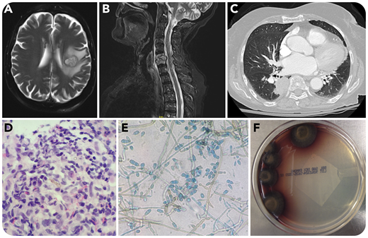 An 84-year-old woman with hypertension, gastroesophageal reflux disease, and polycythemia vera with progression to myelofibrosis on ruxolitinib presented with weakness, falls, dysarthria, and right-sided facial droop. Imaging revealed a 2.1-cm left frontoparietal mass (panel A), a C5/6 osteomyelitis with surrounding phlegmon (panel B), and a 4.3-cm right lower lobe lung mass (panel C). A lung biopsy and fungal culture revealed findings consistent with Verruconis gallopava: pigmented septate hyphae on hematoxylin and eosin (panel D, 40× objective; total magnification, ×400), red-brown with a velvety texture mold colonies (panel F), and 2-celled elongate conidia by lactophenol blue stain (panel E, 40× objective; total magnification, ×400).