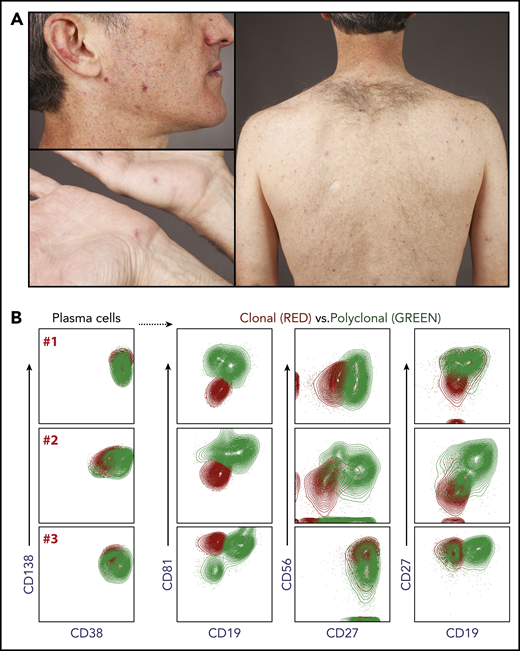 Telangiectasias and flow cytometry. (A) Telangiectasias are most prominent on the face and the trunk and rarely seen on the lower extremities. (B) Extended phenotyping of bone marrow plasma cells from 3 patients (designated A, B, C) with TEMPI syndrome has been performed by flow cytometry using a panel of markers including: CD38, CD138, CD19, CD27, CD56, and CD81. The loss of CD19 appears to be a consistent feature of the monoclonal plasma cell population.