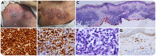 An 88-year-old man with stage 0 chronic lymphocytic leukemia (CLL) developed polymerase chain reaction-proven, varicella-zoster virus (VZV) along the T1 dermatome, treated with acyclovir (panel A). He improved, but 9 weeks later had large pink nodules in the same distribution as the zoster (panel B). Biopsy was CD20+, CD3−, CD5+, CD23+, Bcl-2+, and MUM1+, consistent with a “histologically aggressive CLL” (panel C, ×4 objective, total magnification ×40; panels D-F, ×40 objective, total magnification ×400); a VZV stain was positive (panel G, ×40 objective, total magnification ×400). He refused palliative radiation, and subsequently expired from multiple issues.