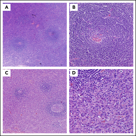 CD histopathology. (A-B) HV histopathology. (A) Low power (hematoxylin and eosin stain; original magnification ×20) and (B) high power (hematoxylin and eosin stain; original magnification ×100). Most commonly seen in UCD, these lymph nodes are often characterized by capsular fibrosis with broad fibrous bands traversing through the lymph node; an increased number of lymphoid follicles are scattered throughout the cortex and medulla with often >1 germinal center sharing the same mantle zone. Mantle zones are broad and composed of concentric rings of small lymphoid cells (“onion skin pattern”). Germinal centers are often depleted of B cells and are predominantly composed of follicular dendritic cells with prominent hyaline deposits. Sclerotic blood vessels penetrating within the germinal centers forming so-called “lollipop lesions” are observed. Follicular dendritic cells can show dysplastic features. The interfollicular region is composed of prominent high endothelial venules with plump endothelial cells, often surrounded by clusters of plasmacytoid dendritic cells and stromal proliferation. PCs, immunoblasts, and eosinophils are also part of the interfollicular infiltrate, but sheets of PCs are not seen. (C-D) PC histopathology. (C) Low power (hematoxylin and eosin stain; original magnification ×20) and (D) high power (hematoxylin and eosin stain; original magnification ×100). Lymph nodes demonstrating PC histopathology are distinguished by the presence of sheets of PCs in the interfollicular zone. The interfollicular region can also contain prominent high endothelial venules. Some eosinophils and mast cells may also be present. There is follicular/germinal center hyperplasia with sharply defined mantle zones and polarized germinal centers, with frequent mitosis and histiocytes with nuclear debris.