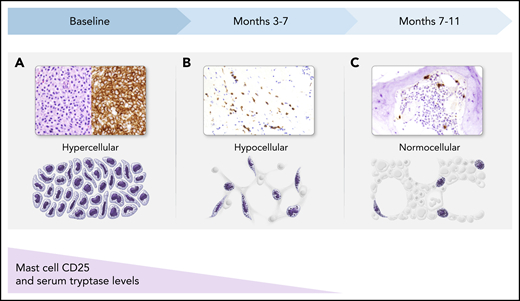 BM response to KIT inhibition in patients with SM. (A) At baseline, atypical (hypogranular, immature, and spindle-shaped) MCs in dense aggregates fill the BM (hematoxylin and eosin stain and CD25 immunohistochemical stain). (B) After a few months of therapy, dense aggregates are few in number, and predominantly loose clusters of MCs are present, with fewer atypical MCs (CD117 immunohistochemical stain). (C) By several months of therapy, only interstitial scattered single MCs remain, which are mostly small, round, and well granulated, with few atypical spindle-shaped MCs (tryptase immunohistochemical stain). During this same time period, MCs that express CD25 initially will lose expression of this aberrant marker, reverting to a normal MC phenotype. Serum tryptase levels similarly decline and generally correlate with MC burden in the BM. All magnification ×40.