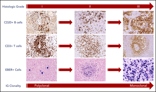 Pathologic findings and histologic grading of LYG. Histologic grading of LYG is based on the number and density of EBV+ atypical B cells and degree of coagulative necrosis. Low-grade (grades 1 and 2) disease is characterized by sparse EBER+ atypical B cells, as well as focal or absent coagulative necrosis. An increased number and size of EBER+ atypical B cells are seen in high-grade (grade 3) disease with often-extensive coagulative necrosis. A reactive angiocentric and angiodestructive CD3+ T-cell infiltrate is another characteristic pathologic feature across all grades of the disease. An increased frequency of monoclonality by molecular analysis is seen with higher grades of disease, likely representative of the progressive transformation of EBV-infected B cells.