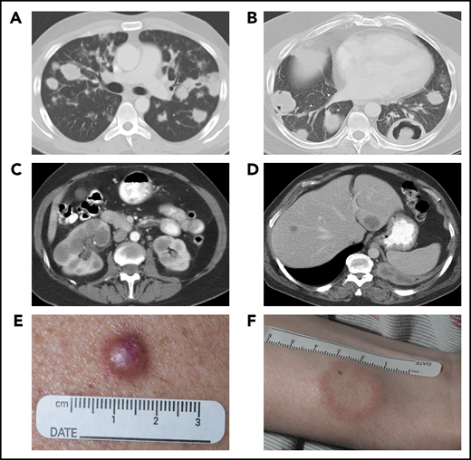 Systemic imaging and cutaneous manifestations of LYG. Computed tomography (CT) of the chest in a 25-year-old man (A) showed multiple, bilateral nodular masses affecting the mid to lower lung fields and in a 43-year-old man (B) showed central necrosis and cavitation in some of the nodular pulmonary lesions. CT of the abdomen in a 57-year-old woman (C) showed multiple, bilateral renal masses and in a 52-year-old man (D) revealed 2 hypodense liver lesions. Photographs of the skin of a 56-year-old man (E), with an erythematous dermal papule without ulceration, and of a 29-year-old man (F), with a white plaquelike lesion with surrounding erythema.
