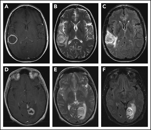 CNS imaging findings in LYG. T1-weighted postcontrast (A,D), T2-weighted (B,E), and fluid attenuation inversion recovery (C,F) sequences from MRI of the brain in a 43-year-old woman (A-C) with LYG demonstrates a large, enhancing right temporal lesion with central necrosis, and in a 39-year-old man (D-F) with LYG demonstrates a large, enhancing left posterior occipital lesion with central necrosis.