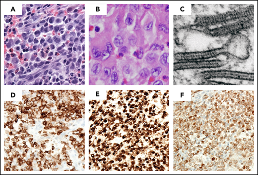 LCH lesion histology. Images demonstrate typical histology of LCH lesion obtained from a bone biopsy with pathologic histiocytes and inflammatory infiltrate. (A-B) Hematoxylin and eosin stain demonstrates histiocytes with pale cytoplasm and reniform nuclei. (C) Birbeck granules on electron microscopy; immunohistochemistry strongly positive for (D) langerin/CD207, (E) CD1a, and (F) S100a. (Courtesy of M. J. Hicks)