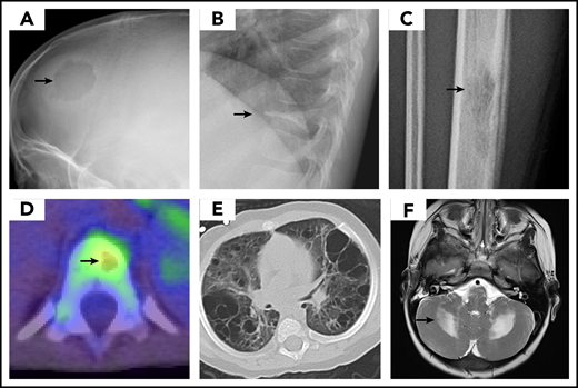 LCH imaging. Images demonstrate typical presentation of LCH lesions including (A) single skull lesion on X-ray, (B) vertebra plana on X-ray, (C) femur lesion on X-ray, (D) vertebral lesion on positron emission tomography/computed tomography scan, and (E) cystic lung disease on computed tomography scan. (F) Brain magnetic resonance imaging demonstrates T2 hyperintensity in cerebellum in LCH-associated neurodegeneration. (Courtesy of P. Campbell)