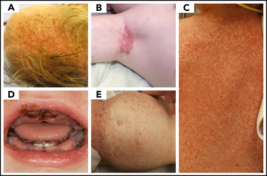LCH skin disease. A range of LCH skin disease is presented. Rashes and skin lesions are pleotropic in LCH and can mimic other more common pediatric rashes associated with (A) cradle cap, (B) eczema, (C) scarlet fever or scalded skin syndrome, (D) herpes gingivostomatitis, and (E) immune thrombocytopenic purpura. (Courtesy of P. Campbell)