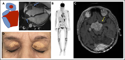 Typical clinical and imaging features of ECD. (A) Mass of the right atrium and of the atrioventricular sulcus (blue arrows). (B) Hypermetabolism of long bones, aorta, and right atrium in 18 fluorodeoxyglucose PET. (C) Pseudotumoral infiltration of brain (MRI, T1 weighted image with gadolinium), yellow arrow. (D) Typical xanthelasma palpebrarum