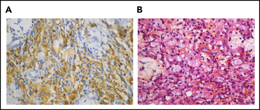 Pericardial localization of ECD. (A) The histiocytes are positive for CD68 (immunostaining with KP1 clone, original magnification, ×400). (B) Pericardial infiltrate made up of histiocytes, some of them with foamy cytoplasm, admixed with a few lymphocytes (hematein-eosin-saffron, original magnification, ×400)