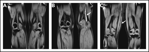 Coronal MRDTI images from 3 study patients. (A) MRDTI negative for DVT with symmetric low signal intensity in both popliteal veins, despite an incompressible popliteal vein in the left leg upon CUS. (B) Asymmetrical high signal intensity in the left popliteal vein diagnostic of acute recurrent DVT of the left leg (arrow). (C) Asymmetrical high signal intensity in the right great saphenous vein diagnostic for acute thrombophlebitis, but not DVT, in the right leg (arrow).