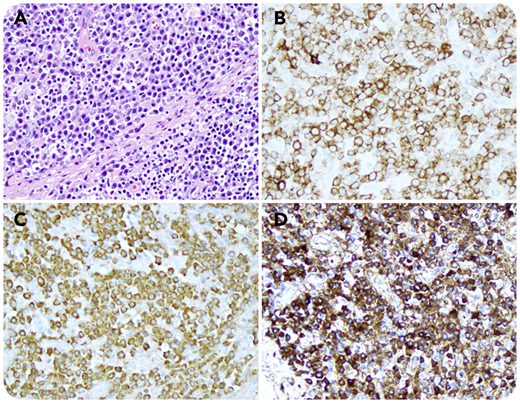 The patient, a 40-year-old healthy man with no past medical history, presented with asymptomatic bilateral enlarged cervical lymph nodes (LNs) of 3 months’ duration. Cross-sectional positron emission tomography/computed tomography revealed supraclavicular, hilar, mediastinal, and axillary LN enlargement; the largest one measured 1.9 cm. Hematoxylin and eosin staining of the resected left cervical LN revealed that the nodal architecture was partially effaced by a well-demarcated large nodule composed of sheets of mature plasma cells (PCs) (panel A, original magnification ×200). These PCs were positive for CD19 (dim) (panel B, original magnification ×200), CD45 (data not shown), λ (panel C, original magnification ×200), and immunoglobulin A (IgA) (panel D, original magnification ×200) but negative for BCL1, CD20, CD56, CD117, Epstein-Barr virus, human herpesvirus-8, IgG, IgM, and κ (data not shown). Next-generation sequencing revealed TET2 mutation (T625fs*11). A bone marrow biopsy 4 weeks later showed a normal cellular marrow with no monotypic PCs. Multiple serum protein electrophoresis and immunofixation from at the time of LN biopsy to December of 2019 revealed a normal κ/λ free light chain ratio and no paraprotein, respectively. Taken together, this is an IgA plasmacytoma, a recently reported indolent and distinct form of extramedullary plasmacytoma.