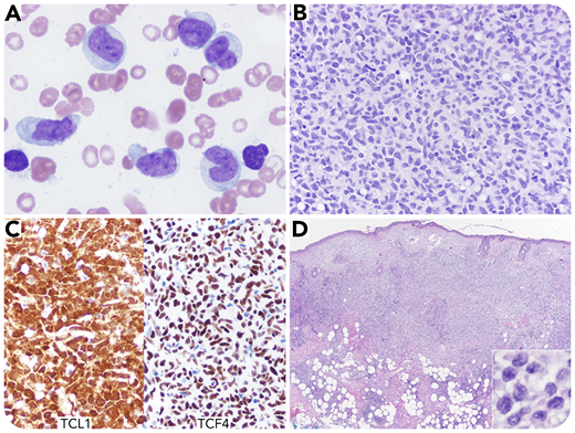 A 69-year-old woman presented with a 4-month history of low-grade fever, night sweats, 30-pound weight loss, and a skin lesion on the abdomen that was treated with antibiotics as a possible infection. At admission, her complete blood count was: white blood cells, 26.2 × 109/L (67% “blasts” with monocytic morphology); hemoglobin, 7.2 g/dL; and platelets, 11 × 109/L. A positron-emission tomography/computed tomography scan revealed extensive systemic hypermetabolic lymphadenopathies, as well as hepatosplenomegaly, pulmonary nodules, and diffuse bone marrow activities. A bone marrow specimen showed similar monocytic blasts (panel A; original magnification ×1000, Wright-Giemsa stain), replacing the entire medullary space (panel B; original magnification ×400, hematoxylin and eosin stain). The blasts in the peripheral blood and bone marrow were positive for CD2, CD4, CD7, CD33, CD38, CD56, CD123, CD303, HLA-DR, TCL1, and TCF4 (panel C; original magnification ×400) and negative for myeloid (CD13, CD15, CD117, and MPO) and monocytic markers (CD11c, CD14, CD64, and lysozyme). A left cheek skin biopsy revealed a tumor with a similar morphology and immunophenotype (panel D; original magnification ×40, insert, original magnification ×1000, hematoxylin and eosin stain). A diagnosis of blastic plasmacytoid dendritic cell neoplasm was established. She was started on hyper–cyclophosphamide, vincristine, doxorubicin, and dexamethasone plus venetoclax.
