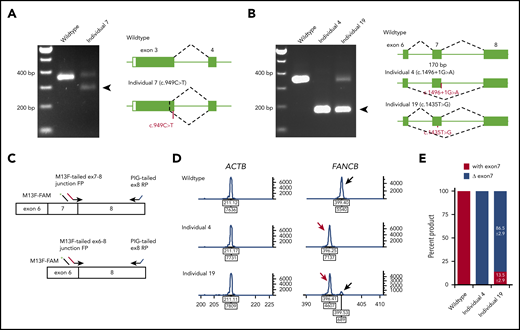 Aberrant FANCB splice products and their quantitation. (A) Reverse transcription PCR (RT-PCR) analysis of fibroblast cell line RNA from individual 7 with c.949C>T (p.Q317*) variant in exon 3. The gel shows, along with the predicted size product, an additional smaller product (arrow) that lacked the last 74 bp from the end of exon 3 (c.878_951del74; p.G294Cfs3*). Both products encode truncated proteins. RNA from a fibroblast cell line from an unaffected individual was used as WT control. (B) RT-PCR analysis of fibroblast cell line RNA from individuals 4 and 19 carrying splice junction c.1496+1G>A and missense c.1435T>G (p.W479G) variants, respectively. Individual 4 RNA shows exclusively exon 7 skipping (c.1327_1496del170; p.K443Vfs*4) (arrow). Individual 19 also shows exon 7 skipping along with a normal size product. (C) Schematics of quantitative fluorescence RT-PCR (qf-RT-PCR) for relative quantification of transcripts with and without exon 7. Two FANCB-specific forward primers (FPs) that bind to either exon 7-8 junction or exon 6-8 junction and a reverse primer (RP) that binds to exon 8 were designed to amplify products from transcripts with (top) or without exon 7 (bottom), respectively. The product with exon 7 is 3 bp longer than that from the product without exon 7. FAM-labeled M13 FP (M13F-FAM) was included to generate fluorescently labeled products. (D) Representative qf-RT-PCR profiles from individuals 4 and 19. Product size and intensity are on the x- and y-axes, respectively; both numbers are shown under each peak. The left panel shows products from ACTB, an internal transcript control. The right panel shows FANCB products. The fragment size for products with exon 7 (black arrow) and without exon 7 (red arrow) appeared around 399 and 396 bp, respectively. Data from WT, individual 4, and individual 19 are presented on the top, middle, and bottom rows, respectively. (E) Percentage of transcripts with or without exon 7; average from 8 independent assays.