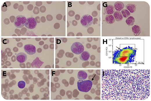 A 54-year-old man was admitted with a 4-week history of recurrent fever, fatigue, and shortness of breath. He had generalized lymphadenopathy, bilateral pleural effusions, splenomegaly, increased lactate dehydrogenase, and polyclonal hypergammaglobulinemia. Hemoglobin was 10.8 g/dL, leukocytes were 21.1 × 109/L (57% neutrophils, 32% lymphocytes, 7% monocytes, 4% eosinophils), and platelets were 207 × 109/L. The blood smear revealed 20% bizarre lymphoid cells with pronounced nuclear convolutions. Most had 3 to 5 nuclear lobulations and a collar of perinuclear vacuoles. Others had round, folded nuclei (panels A-D; original magnification ×1000; May-Grünwald-Giemsa stain). There were also 4% plasmacytoid lymphocytes (panel E; original magnification ×1000; May-Grünwald-Giemsa stain) and immunoblast-like cells (panel F, arrow; original magnification ×1000; May-Grünwald-Giemsa stain). Pleural fluid cytology showed infiltration by the same abnormal lymphoid cells with a single strand of vacuoles around the nucleus giving a “choker necklace” appearance (panel G; original magnification ×800; May-Grünwald-Giemsa stain). Flow cytometry revealed CD3−CD4+CD5+CD7dimCD25−TCL1− T cells coexpressing CD10 and CD200 (panel Η), indicating a T-follicular-helper-cell phenotype. HTLV-1 antibody was negative. These findings suggested a diagnosis of angioimmunoblastic T-cell lymphoma (AITL). Lymph node biopsy showed replacement by abnormal tissue consisting of plasma cells, eosinophils, vascular tissue, and abnormal lymphoid cells (panel I; original magnification ×200; hematoxylin and eosin stain), the latter being CD4+CD10+BCL6+, consistent with AITL. Bone marrow biopsy showed involvement with a similar cellular infiltrate.