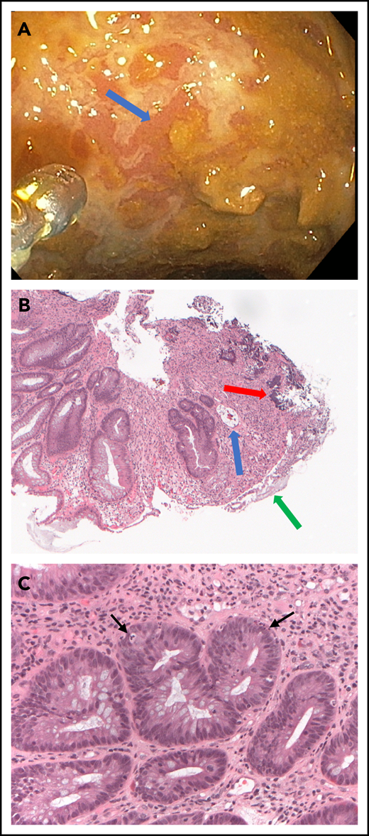 Endoscopic and pathologic evaluation of the sigmoid colon on day 525 after transplantation. (A) Endoscopic view of the colon shows serpiginous ulceration of the mucosal surface (arrow). (B) Low-power view of colon biopsy shows atypical glands indicating regeneration, intramural bacteria (red arrow), fibrinous debris coating denuded luminal surface (green arrow), and an exploded crypt lacking viable cells (blue arrow). Hematoxylin and eosin, original magnification, ×5. (C) High-power view shows crypts with apoptotic cells (arrows) and intense inflammatory infiltrate surrounding the crypts. Hematoxylin and eosin, original magnification, ×20.