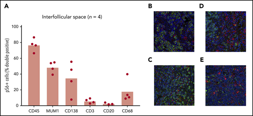 Identification of cell types with increased mTOR activation. (A) Co-IF for CD45, MUM1, CD138, CD3, CD20, and CD68 was performed to identify the cell types expressing pS6 in 4 iMCD-TAFRO cases (CD20 staining was only performed in 3 cases). Representative images (×20) are shown in panels B-E, where pS6 was stained red and the cell specific marker green: (B) CD138, (C) CD3, (D) CD20, (E) CD68. Labeled cells were manually counted to assess for percentage of pS6+ cells. A majority of pS6+ cells were of the hematopoietic lineage (CD45+). Only a small fraction (2% to 10%) of pS6+ cells were T cells (CD3+). A large proportion of cells expressed the transcription factor MUM1, which is expressed on activated B cells, T cells, and plasma cells. Plasma cells (CD138+) and macrophages (CD68+) also made up a large proportion of pS6+ cells.