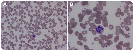 A 39-year-old woman developed paresthesia and macrocytic anemia (hemoglobin, 9.9 g/dL; reference range, 12-16 and mean corpuscular volume, 113 fL; reference range, 80-100). Cyanocobalamin (B12) deficiency was strongly suspected; surprisingly, the initial B12 level returned elevated at 1328 pg/mL (reference range, 180-914). A Romanowsky-stained peripheral smear was obtained (panel A: original magnification ×500; panel B: original magnification ×1000) showing anisopoikilocytosis, oval macrocytes, and hypersegmented neutrophils with >5 lobes. Methylmalonic acid (MMA) and homocysteine were elevated. B12 is required as a cofactor for the conversion of homocysteine to methionine and MMA to succinyl–coenzyme A, thus leading to elevated levels of both with B12 deficiency. The B12 level on a different analyzer returned low at 65 pg/mL (reference range, 301-1100). Intrinsic factor antibodies (IFAs) were strongly positive. She was diagnosed with pernicious anemia and given B12 replacement, with complete resolution of her neurologic symptoms and anemia.