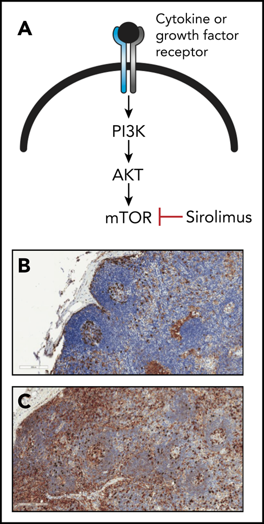 The activity of the mTOR signaling pathway is elevated in lymph nodes from patients with iMCD. (A) Schematic diagram outlining the mTOR signaling pathway, which is activated by engagement of cytokine or growth factor receptors with their respective ligands. The mTOR inhibitor sirolimus is used clinically to block mTOR signaling. (B-C) Lymph node sections from a control patient (B) or a patient with iMCD (C). Sections were stained with antibodies specific for the phosphorylated form of the ribosomal protein S6 (pS6; brown color), which becomes phosphorylated in response to mTOR signaling. Note the elevated levels of pS6 in the lymph node section from the iMCD patient relative to that from control, which signifies greater activation of mTOR signaling. The blue color represents staining of cell nuclei with hematoxylin. Original magnification ×20 for panels B-C. See Figure 1 in the article by Arenas et al that begins on page 1673.