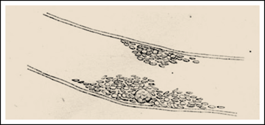 From the work of Giulio Bizzozero.11 Bizzozero, a pathologist working in Pavia, is credited for the first report of platelets being potentially implicated in thrombosis. The sketch depicts a thrombus made up of platelets on a vessel wall lining, with a leukocyte clearly visible inside. (The original figure was in an opposite orientation.)