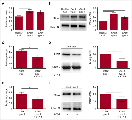 Proliferation of CALR type I Mks is counteracted by SOCE inhibition. (A) Cell proliferation assay of Mk culture from healthy controls (Ctrl) and CALR type I and type II patients (n = 8 per subgroup; P < .05). (B) Representative western blot analysis of PCNA expression in mature Mks from healthy control (ctrl) and CALR type I and type II patients. β-ACTIN was used to ensure equal loading. The band densitometry analysis of 3 independent experiments is shown (P < .05). (C) Cell proliferation assay of cytokine-starved CALR type I Mks in presence or not of the SOCE inhibitor BTP-2 (20 μM) (n = 3; P < .05). (D) Western blot analysis of PCNA expression in cytokine-starved CALR type I Mks cultured in absence (−) or presence (+) of 20 µM BTP-2. β-ACTIN serves as loading control. The band densitometry analysis of 3 independent experiments is shown (P < .05). (E) Cell proliferation assay of cytokine-starved CALR type II Mks in presence or not of BTP-2 (20 μM) (n = 3; P < .05). (F) Western blot analysis of PCNA expression in cytokine-starved CALR type II Mks cultured in absence (−) or presence (+) of 20 µM BTP-2. β-ACTIN serves as loading control. The band densitometry analysis of 3 independent experiments is shown (P < .05).