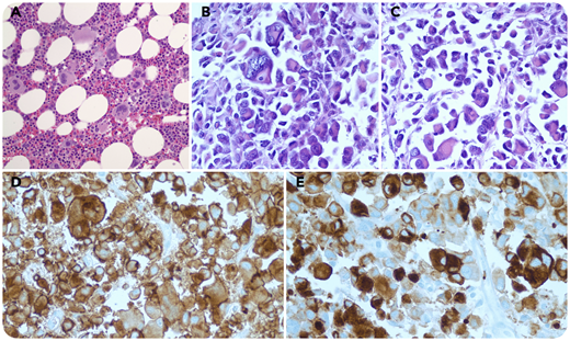 A 72-year-old man with a history of long-standing essential thrombocythemia presented with progressive and generalized weakness (panel A, hematoxylin and eosin stain at ×40 magnification of prior bone marrow biopsy in 2010, showing a hypercellular marrow with increased numbers of hyperlobated megakaryocytes without fibrosis; cytogenetic and molecular results unavailable). His laboratory results showed a neutrophilic leukocytosis (26 300/μL), anemia (10.1 g/dL), and marked thrombocytosis (1 190 000/μL). The patient’s symptoms were worked up, and he was found to have had a stroke secondary to increased platelets and a hypercoagulable state. In addition, the patient had mediastinal and supraclavicular lymphadenopathy, and a supraclavicular lymph node core biopsy was performed. The biopsy showed an infiltrate of large, pleomorphic, and poorly cohesive cells with abundant eosinophilic cytoplasm and occasional multinucleation (panels B and C, hematoxylin and eosin stain of lymph node at ×50 magnification). Immunohistochemistry showed the large atypical cells to be positive for CD45, CD34, CD61, and factor VIII (panel D, CD34 stain; panel E, CD61 stain, both at ×50 magnification).