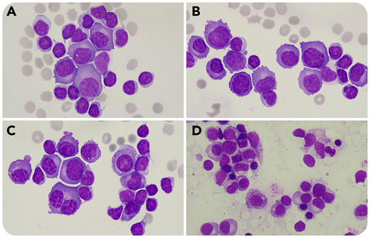 A 79-year-old woman presented with asthenia, anorexia, weight loss, and low back pain. Chest radiograph showed a moderate bilateral pleural effusion (PE). Analysis of pleural fluid showed 2623 × 106 nucleated cells per L, 3002 × 106 erythrocytes per L, protein concentration of 50.2 g/L, and negative microbiological tests. Microscopic observation of a cytocentrifuged sample revealed 74% lymphocytes and the presence of 26% medium-to-large size atypical cells with round eccentric nuclei (some cells were binucleated) and basophilic cytoplasm compatible with atypical plasma cells (PCs) (panels A-C: pleural fluid; 100× objective; May-Grünwald-Giemsa stain; original magnification ×1000). These cells were CD138 positive by flow cytometry, confirming the presence of PCs in the PE. Capillary electrophoresis and immunofixation in serum demonstrated monoclonal immunoglobulin G (IgG) λ and free λ chains. Bone marrow (BM) aspirate contained 25% PCs (panel D: BM; 50× objective; May-Grünwald-Giemsa stain; original magnification ×500), IgH rearrangement, and translocation (11;14). Computed axial tomography showed posterior paravertebral mediastinal tumor, which is suggestive of plasmocytoma. The patient was finally diagnosed with IgG λ multiple myeloma (MM).
