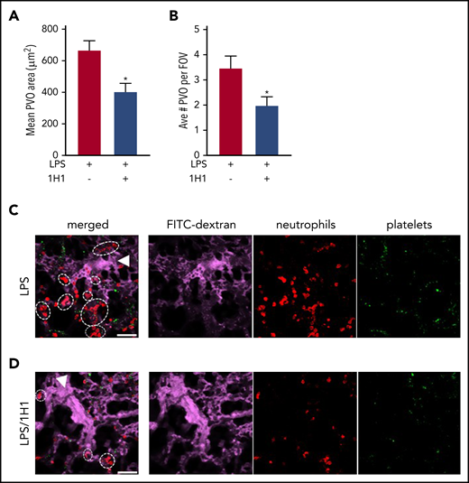 TF inhibition attenuates formation of LPS-induced pulmonary vaso-occlusions in SCD mice. The effect of anti-TF 1H1 antibody (5 mg/kg, IV) on the formation of neutrophil/platelet microemboli. 1H1 was administered 30 minutes prior to infusion with LPS (0.1 µg/kg, IV). Arterioles were imaged 2 to 2.5 hours after LPS infusion using qFILM. The mean pulmonary arteriolar vaso-occlusion (PVO) area (A) and average number of PVO per field of view (FOV) (B) were quantified in control sickle mice (black) or sickle mice treated with 1H1 (gray). n = 5 mice per group. Representative qFILM images of lungs from a control sickle mouse (C) or from a sickle mouse treated with 1H1 (D). The far left panels represent merged images of the circulation (FITC-dextran, purple), neutrophils (red), and platelets (green). Arrowheads denote the direction of blood flow, and dashed ovals and circles denote PVOs. Scale bars, 50 µm. *P < .05, 2-tailed, unpaired Student t test.