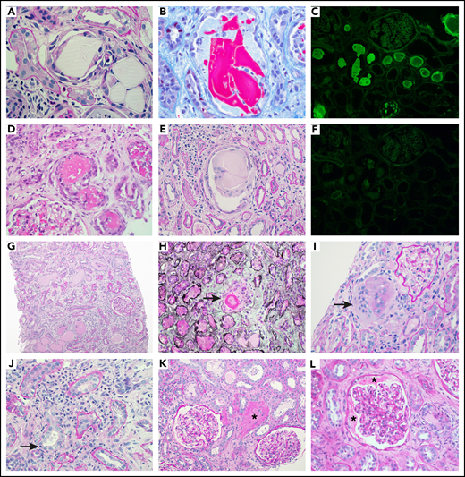Pathology illustrations. Intraluminal LC casts with the typical appearance. By light microscopy: (A) sharp-edged periodic acid–Schiff negative casts surrounded by a cellular reaction (magnification ×600), (B) fractured cast on trichrome stain (magnification ×600), (D) eosinophilic granular casts on hematoxylin and eosin stain (magnification ×400), and (E) multinucleated giant cell reaction around a fractured cast (magnification ×400). By immunofluorescence: (C) positive staining with anti-κ (magnification ×100) and (F) negative staining with anti-λ (magnification ×100). Images of pathology features that were recorded: (G) extensive interstitial fibrosis and tubular atrophy with scarce mononuclear interstitial inflammation (periodic acid–Schiff, magnification ×100), (H) tubular rupture with the interruption of the tubular basement membrane (arrow) (Jones methenamine silver, magnification ×400), (I) interstitial giant cells (arrow) (periodic acid–Schiff, magnification ×400), (J) interstitial inflammation with tubulitis (arrow) (periodic acid–Schiff, magnification ×600), (K) THP extravasation into the interstitium (asterisk) (periodic acid–Schiff, magnification ×200), and (L) THP protein in the Bowman’s space (asterisks) (periodic acid–Schiff, magnification ×400).